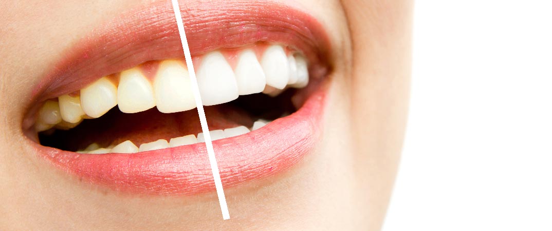 美白牙齒可使牙齒亮白，但過白的貼片會使牙齒顯得不自然。