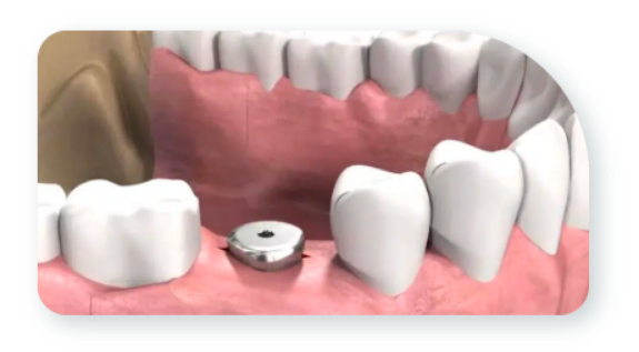 牙醫首先會在齒槽骨置入植體