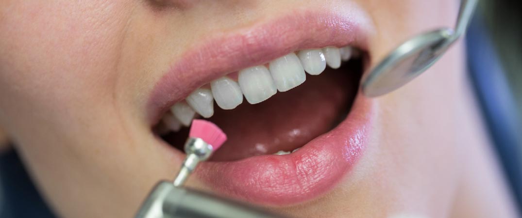 在貼上全瓷美白牙貼前，必須把牙齒的牙石清潔乾淨。