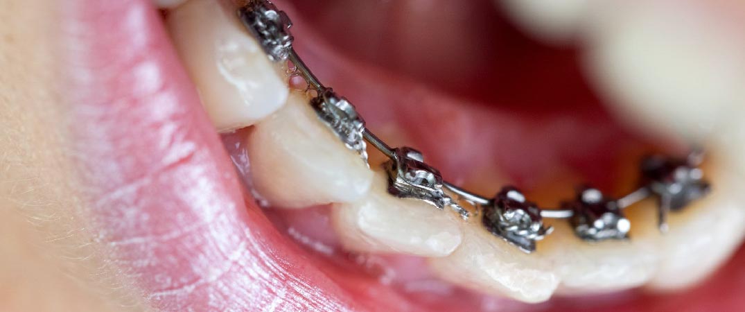 牙箍安裝的位置轉變為牙齒內側