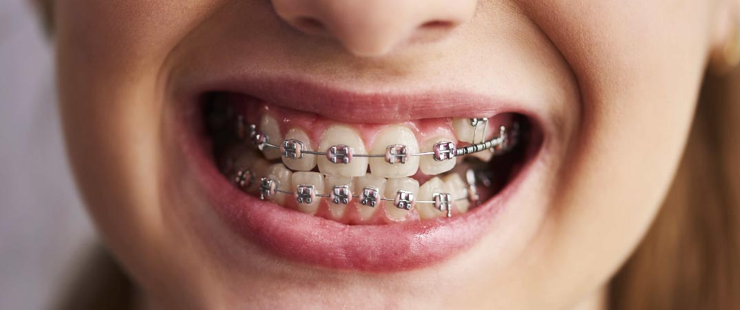 自鎖式牙箍能夠輕易因應牙齒的狀況而調整