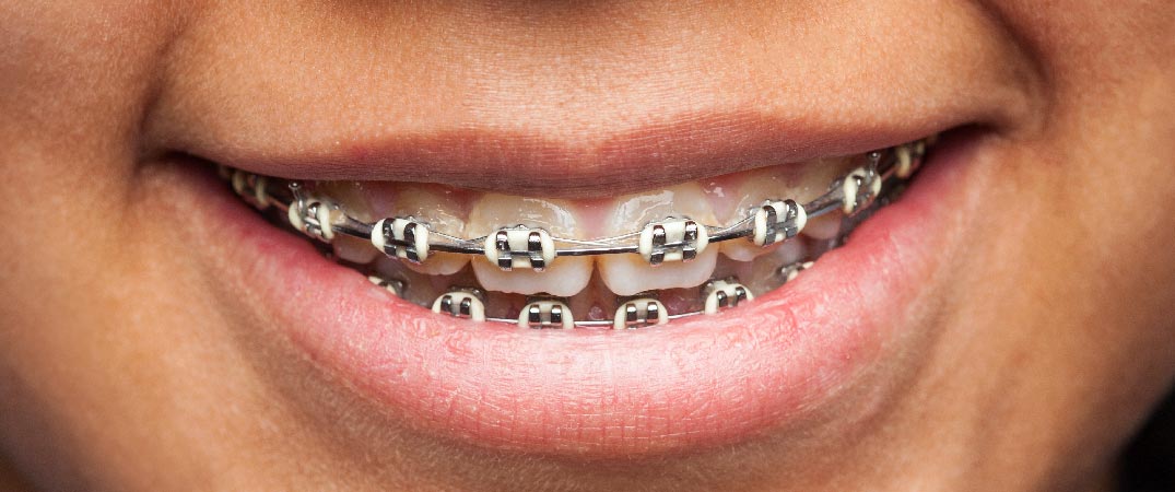傳統箍牙要使用到金錢鋼線與支架