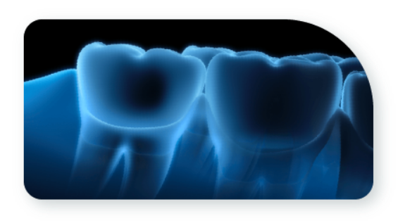 牙醫將會檢查你的齒槽骨深度是否適合直接植牙