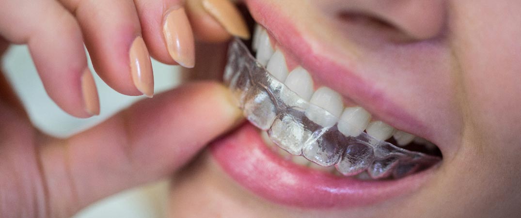 用家可以自行更換隱形牙套，新牙套會有適應期。