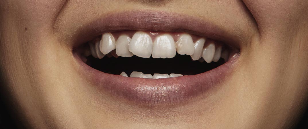 如果一個牙齒缺失，它周圍的牙齒可能會移動來填補空缺