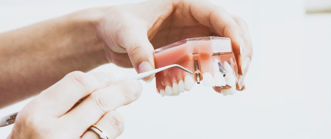缺牙的位置直接植入人工牙根，再在牙根上安裝人工牙冠