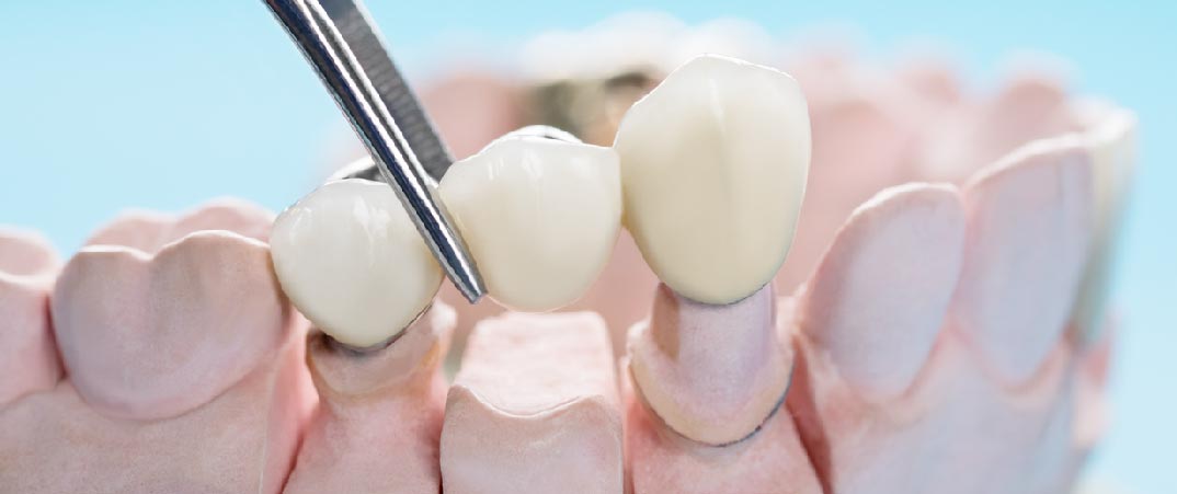 牙橋在缺牙的位置上架設一個或多個牙齒